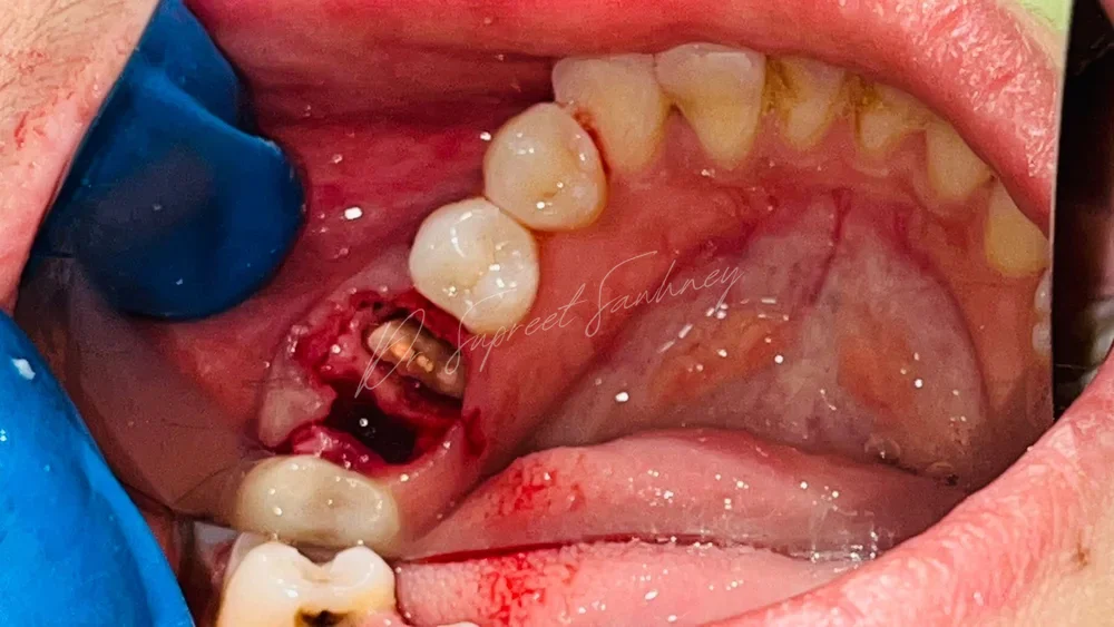 Intraoperative posterior mandibular view of the implant site after osteotomy preparation